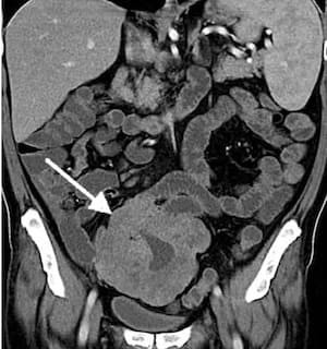 КТ-энтерография тонкого кишечника снимок